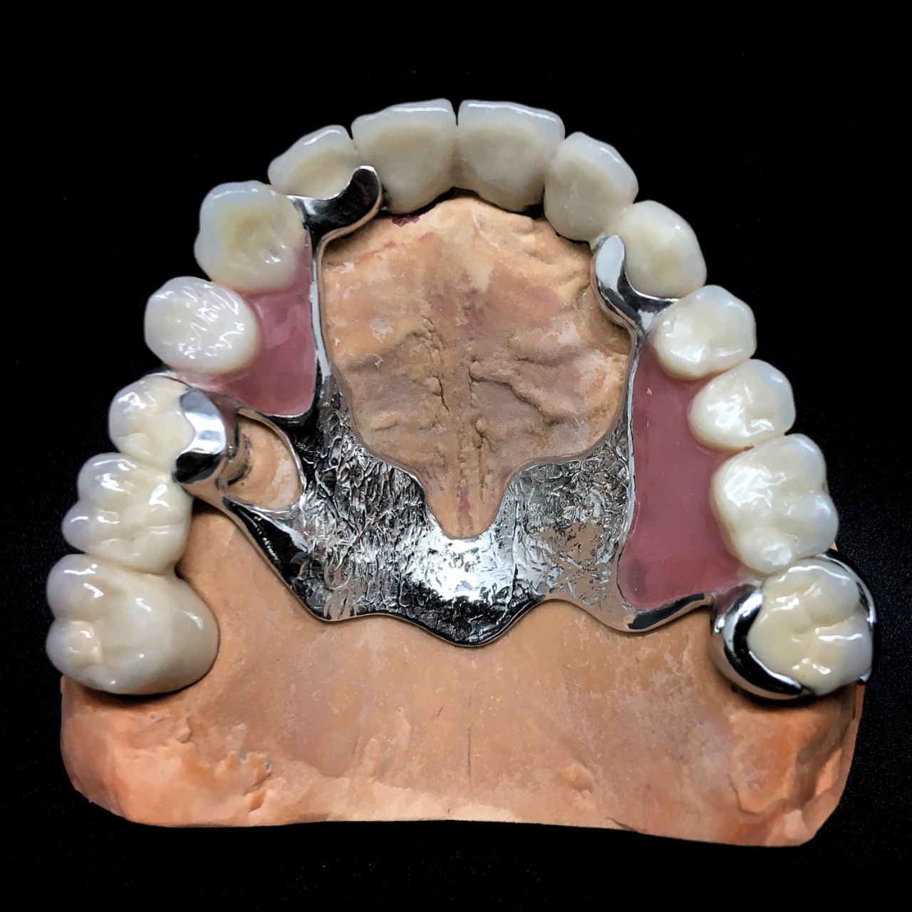 Бюгельные протезы для зубов на верхнюю челюсть фото